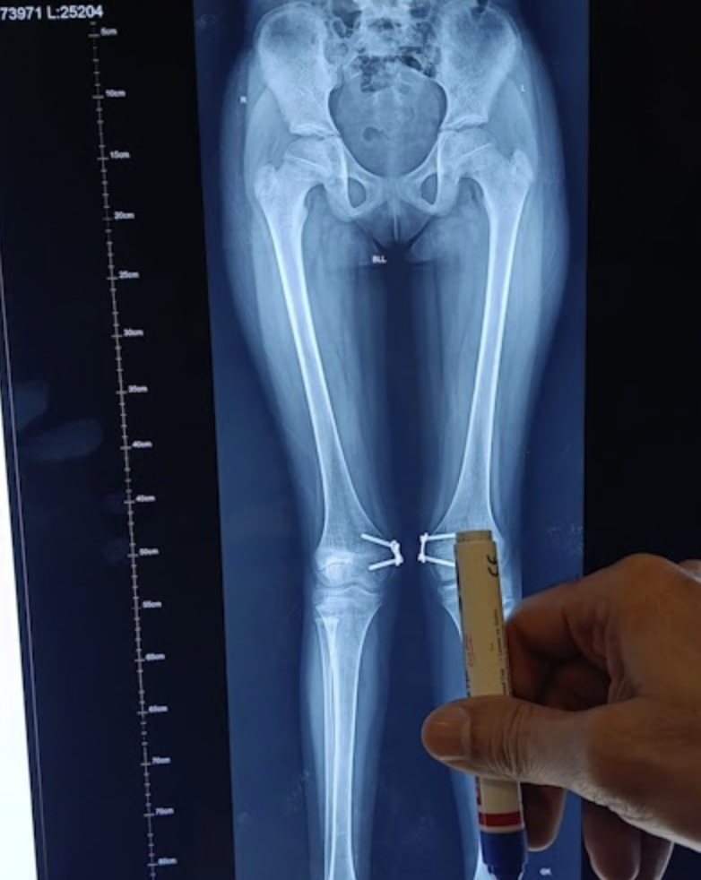 Full-length X-ray used to assess knock-knees alignment