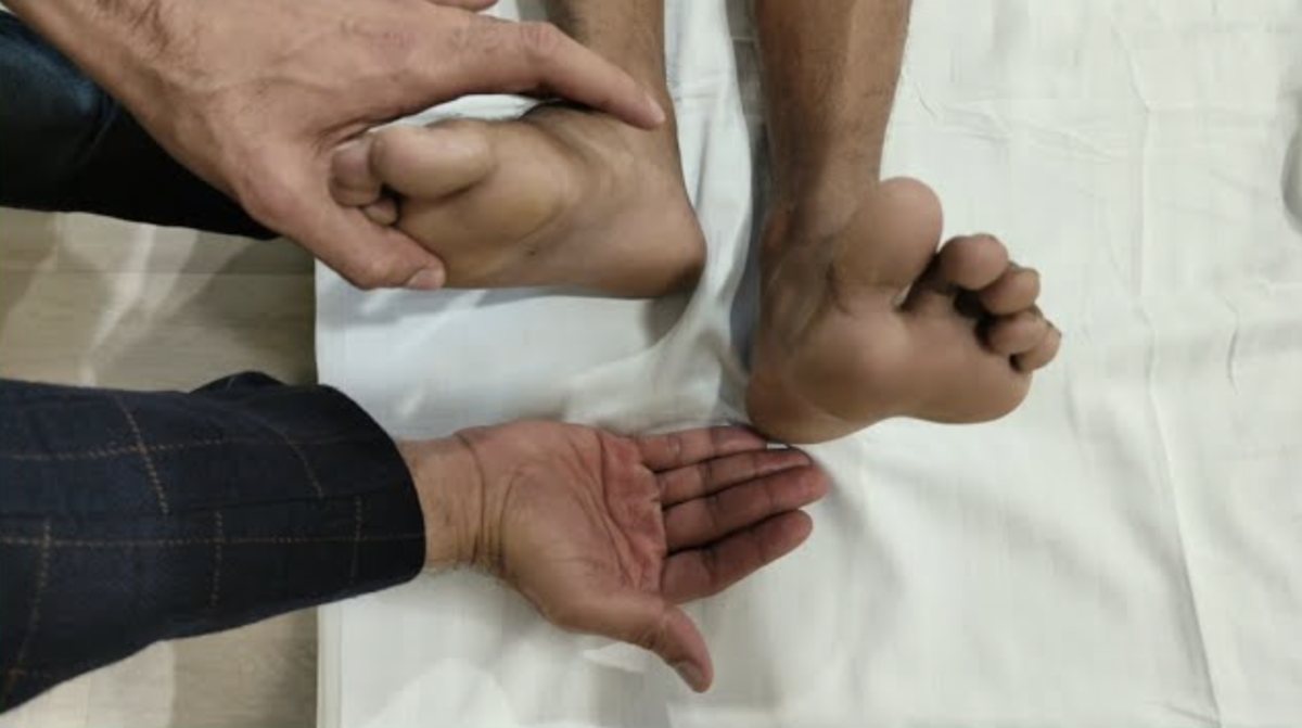 Limb lengthening assessment by Dr. Ashwani Maichand