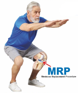 Patient squatting comfortably after Meniscus Replacement Procedure (MRP) — deep knee flexion restored