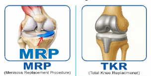 Knee diagram comparison — Meniscus Replacement Procedure (MRP) preserves the natural joint vs Total Knee Replacement (TKR) artificial implant