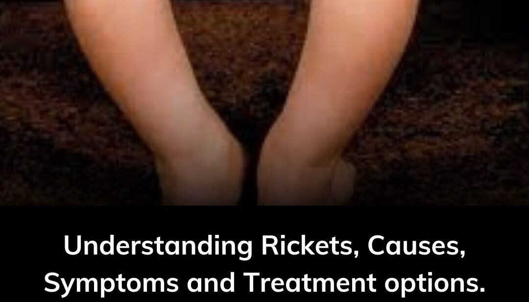 Understanding Rickets: Causes, Symptoms, and Treatment Options