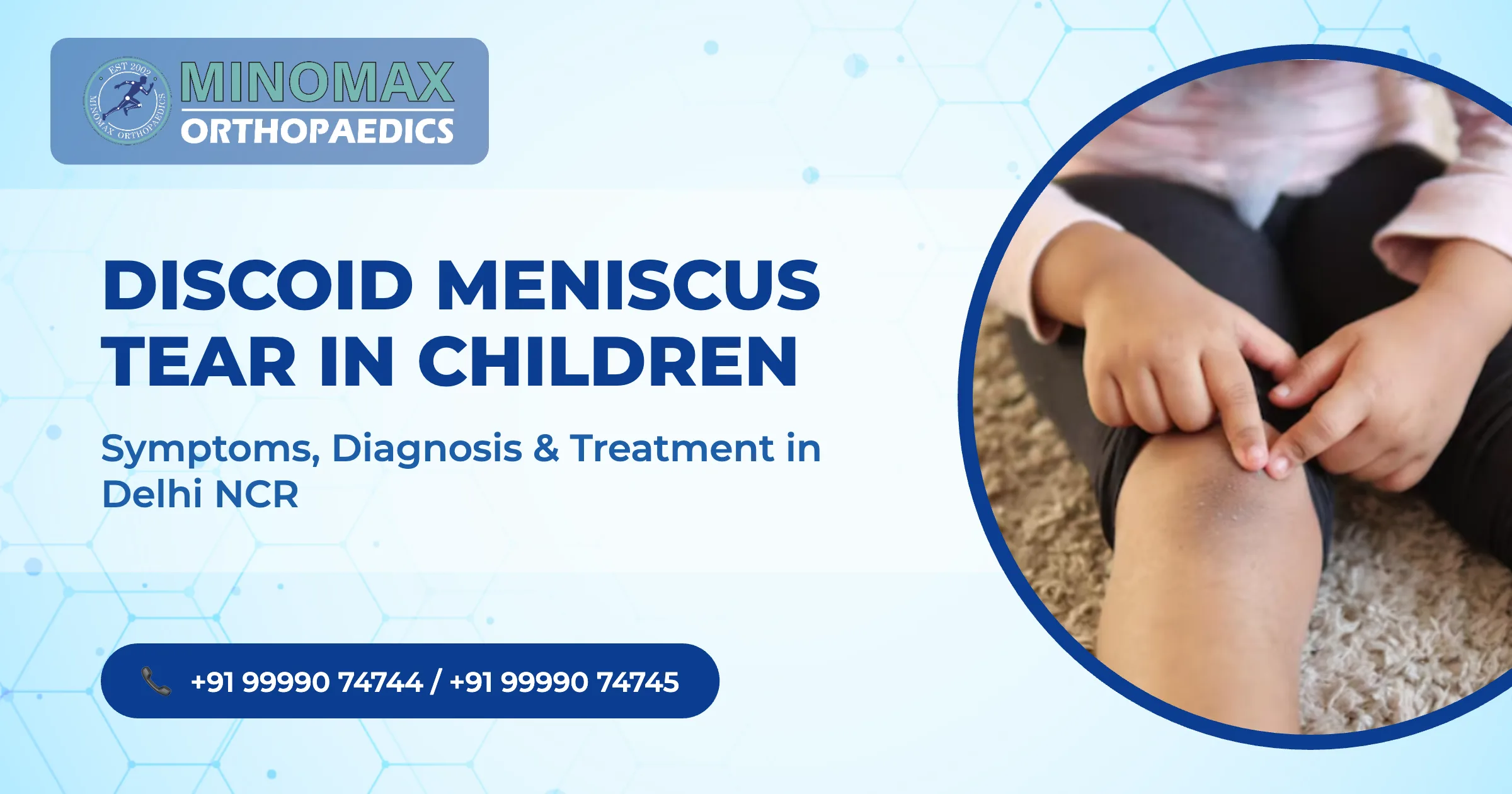 Discoid Meniscus Tear in Children: Symptoms, Diagnosis & Treatment in Delhi NCR