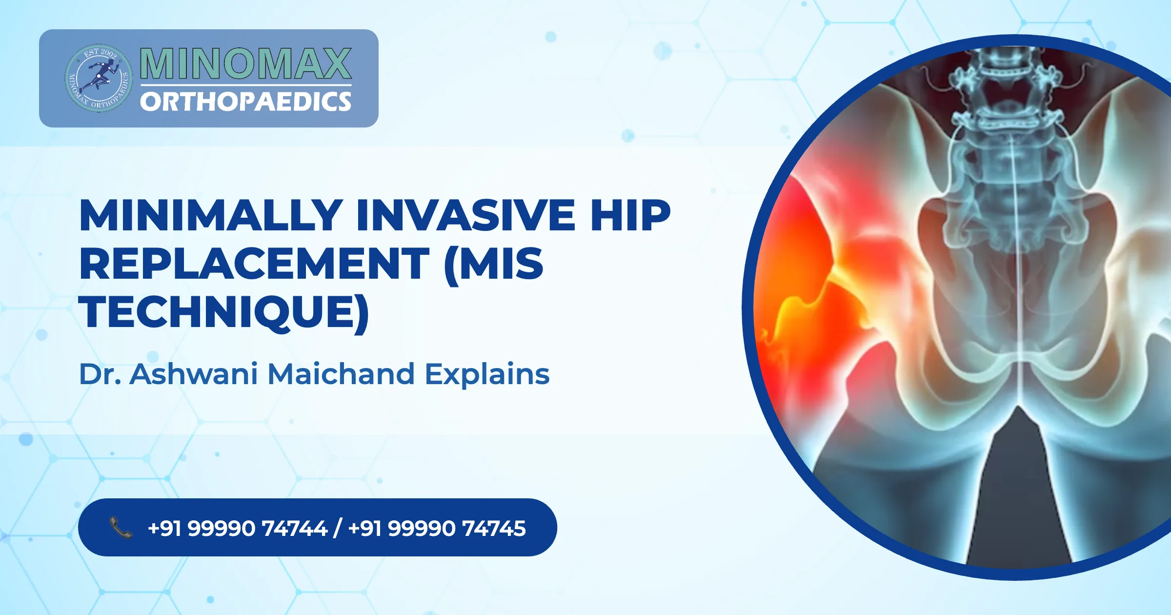 Minimally Invasive Hip Replacement (MIS Technique)