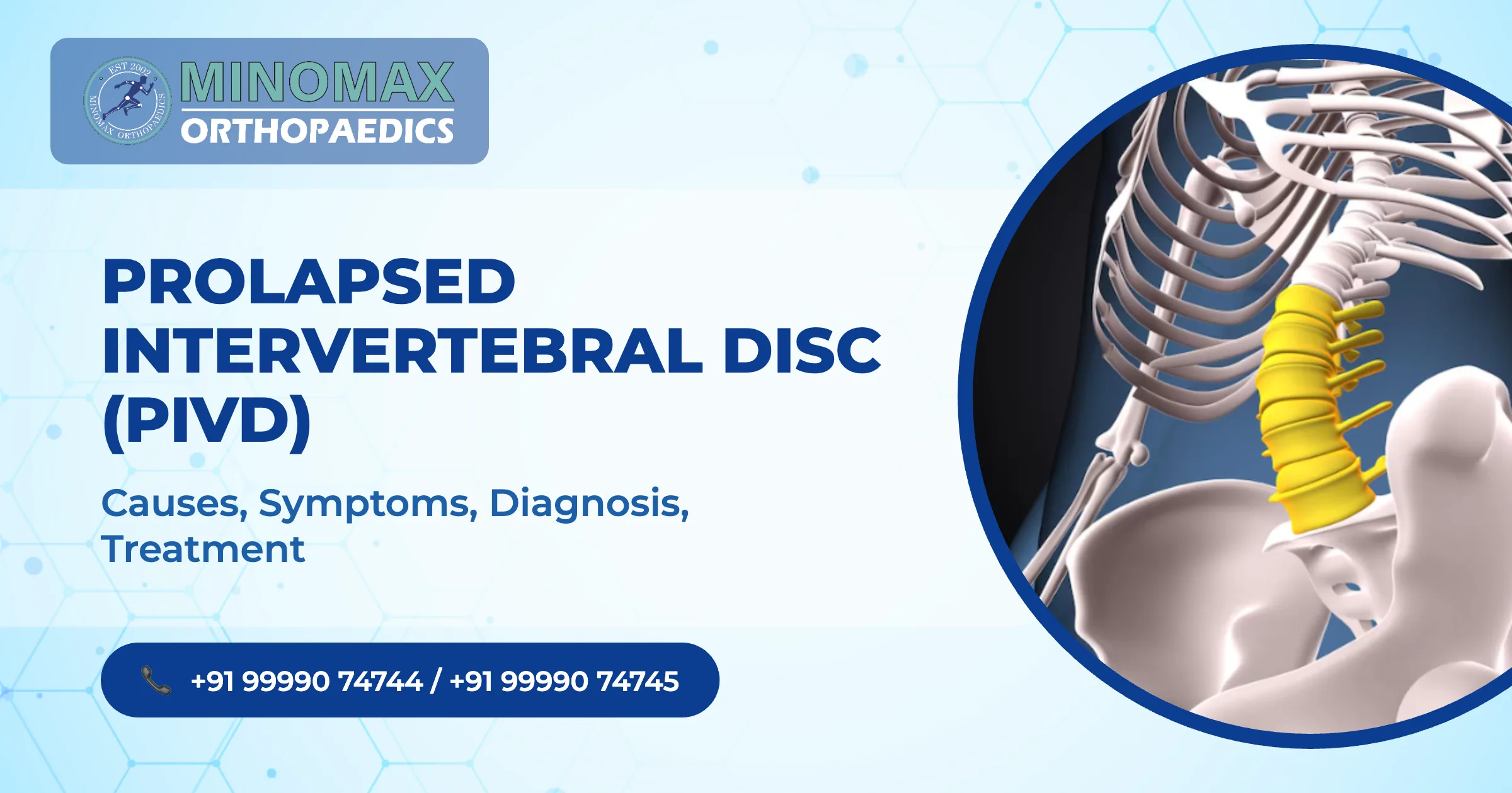 Prolapsed Intervertebral Disc (PIVD): Causes, Symptoms, Diagnosis, Treatment