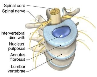 Prolapsed Intervertebral Disc (PIVD): Causes, Symptoms, Diagnosis ...