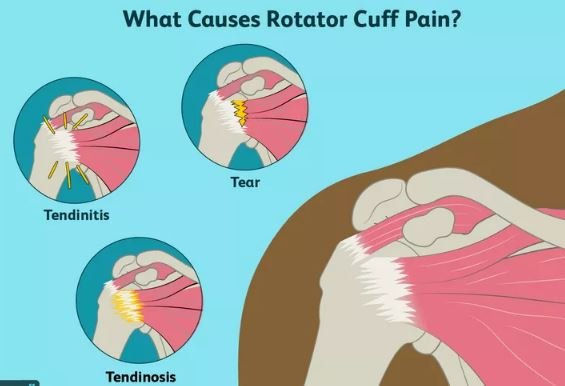 Rotator Cuff