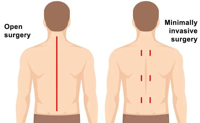 Open Surgery v/s Minimally Invasive Surgery