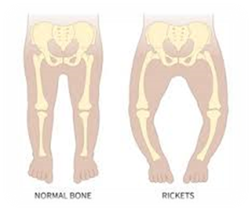 Normal Bona & Rickets 