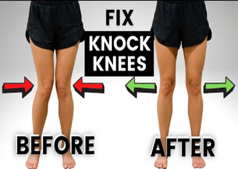 Knock Knees