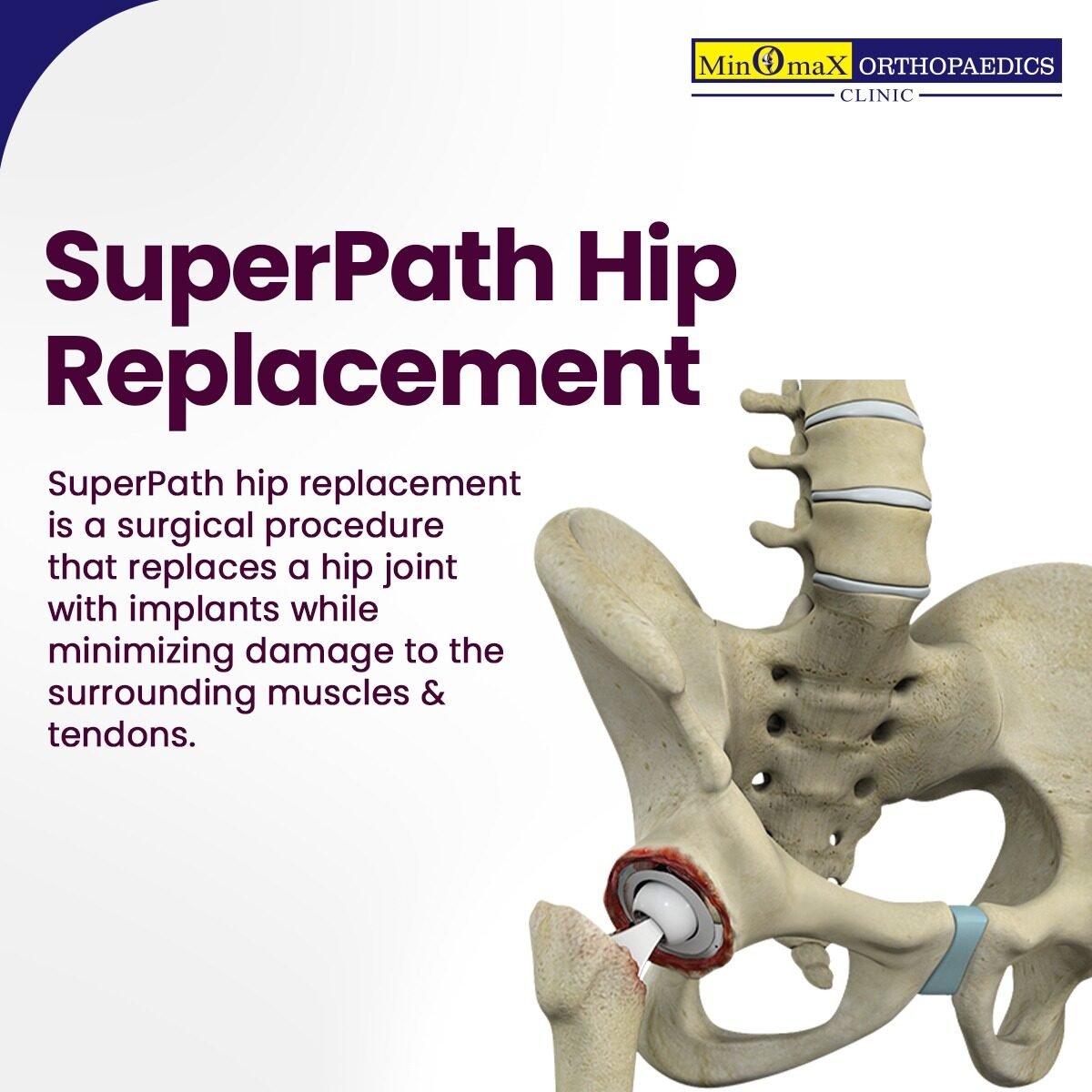 SuperPath Hip Replacement