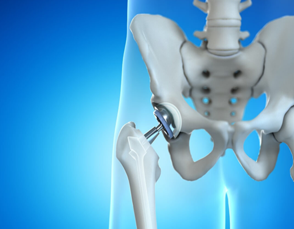 MIS Hip Replacement for Ankylosing Spondylitis